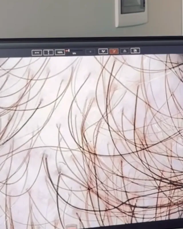 Lo schermo dello scanner tricologico: i capelli ingranditi, uno per uno, per contarli e misurarli