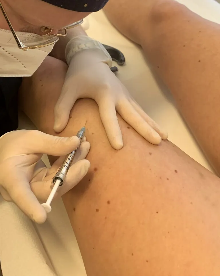 Le mani guantate e l'ago sottile della scleroterapia sui capillari della gamba